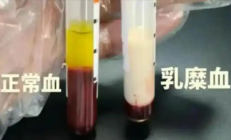 男子抽出草莓奶油血 医生紧急提醒：血脂长期偏高要注意