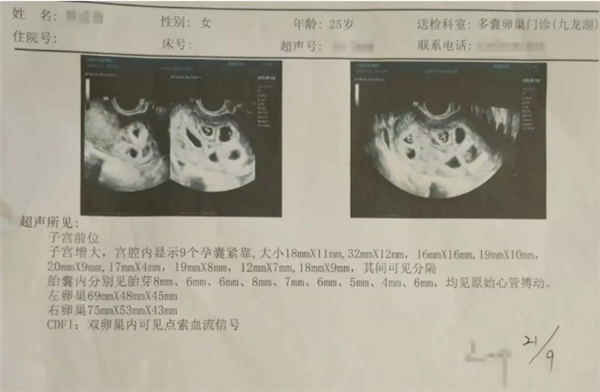 女子促排备孕怀上9胞胎 丈夫：担心老婆身体