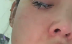 女子误将502喷入眼中睫毛全被拔 就医后保住视力