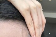 张靓颖自曝体检查出营养不良：额头血管莫名突起 伸懒腰手掌就流血