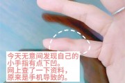 用小拇指做手机支架的受害者出现了：手指出现明显凹痕