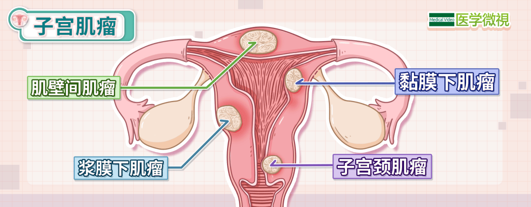 女星切除子宫肌瘤3个月后复发，这是一种什么病？ 子宫肌瘤 第2张