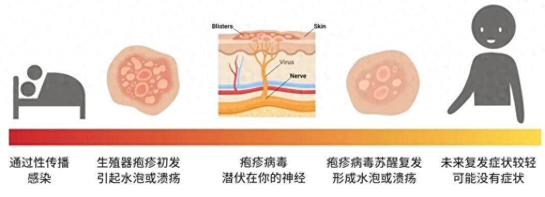 生殖器疱疹患者的平均寿命是多少？真的会比普通人短吗？ 生殖器疱疹 第2张