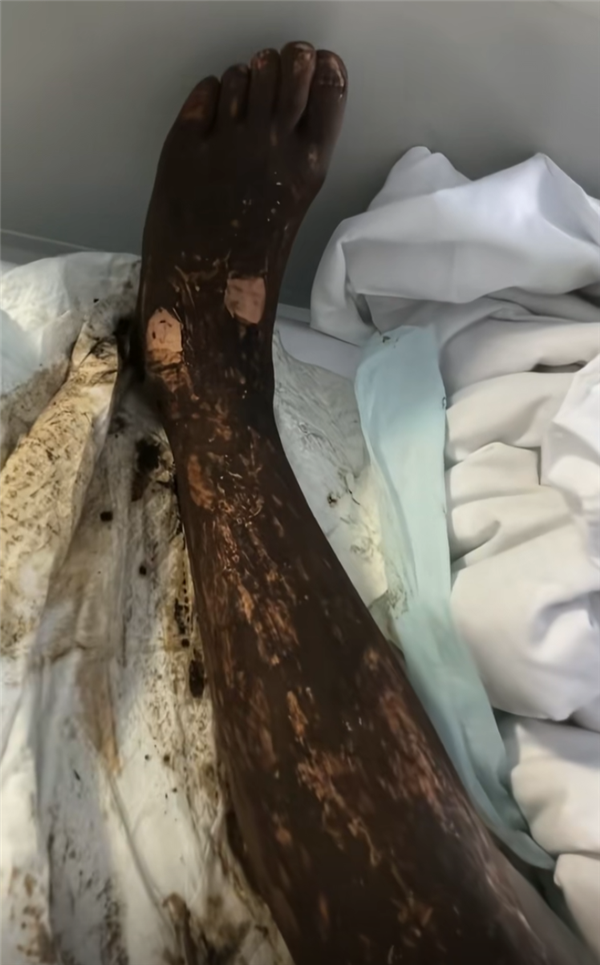 男子同时被五步蛇和竹叶青咬伤 腿严重肿胀 网友:这概率买彩票吧 第6张 男子同时被五步蛇和竹叶青咬伤 腿严重肿胀 网友:这概率买彩票吧 第6张
