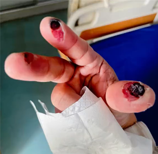 别名“化骨水”!女子散步时踩到氢氟酸后不幸去世 氢氟酸 第4张 别名“化骨水”!女子散步时踩到氢氟酸后不幸去世 氢氟酸 第4张