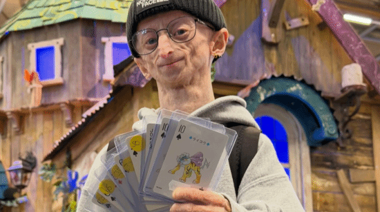 早衰症网红28岁去世！面容枯槁已是“高寿”平均15岁 早衰症 第1张